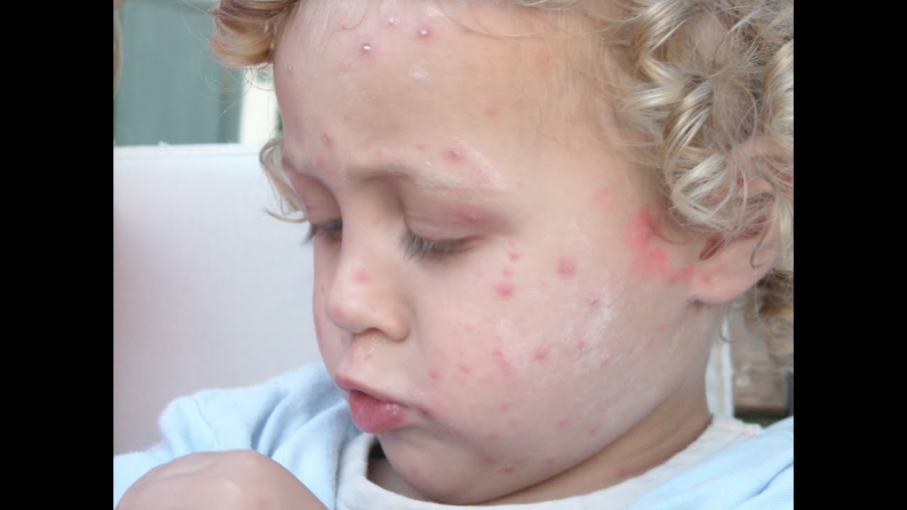 Shingles In Children, Signs Of Shingles, Herpes Zoster ...