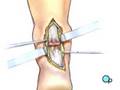 PreOp® Patient Education: Achilles Tendon Repair Surgery