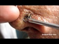 Black & White Heads On Nose Part 2