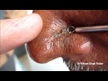 Black & White Heads On Nose Part 2