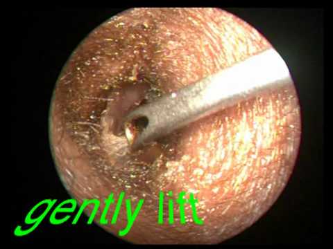 removal of impacted ear wax