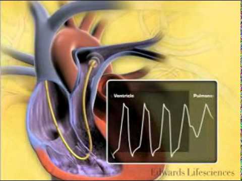 Swan Ganz Physiology - YouTube