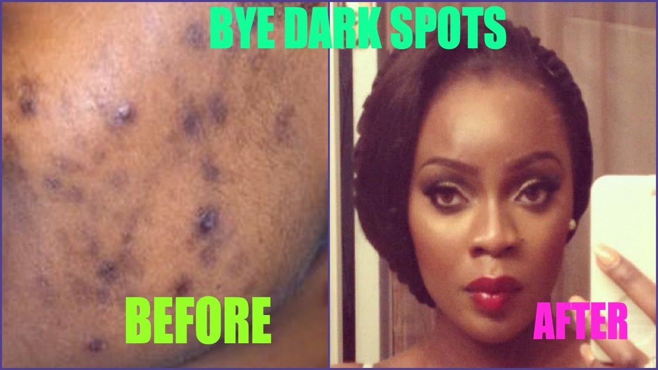 Be Treating dark skin  ACNE for YouTube GIVEAWAY  Spots makeup scars with acne Gone  Dark