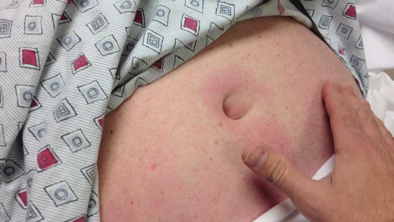 umbilical hernia - with fat herniation - YouTube