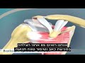 שקט מנתחים - ניתוחי כתף