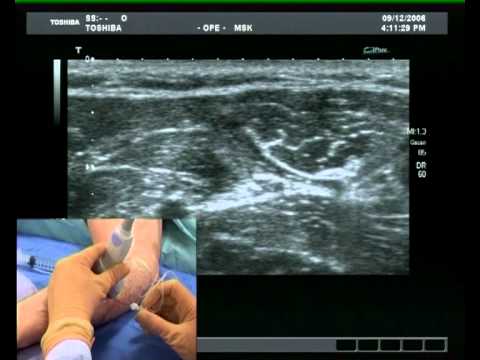 Ulnar nerve block (ultrasound guided) - YouTube