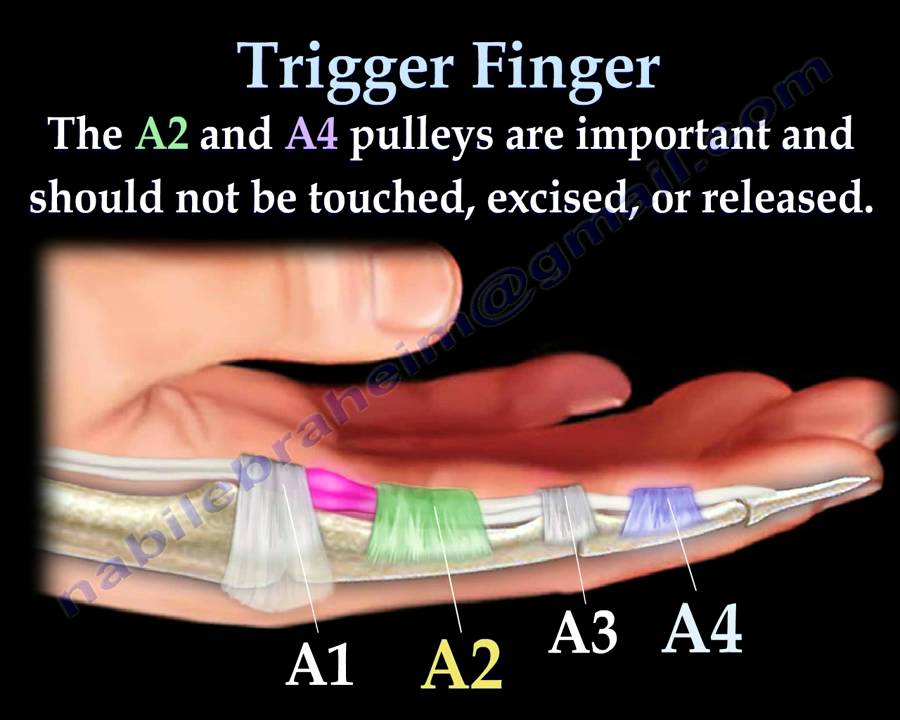 Trigger Finger and thumb - Everything You Need To Know - Dr. Nabil