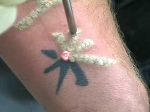 Laser Tattoo Removal with Fotona's QX MAX - YouTube