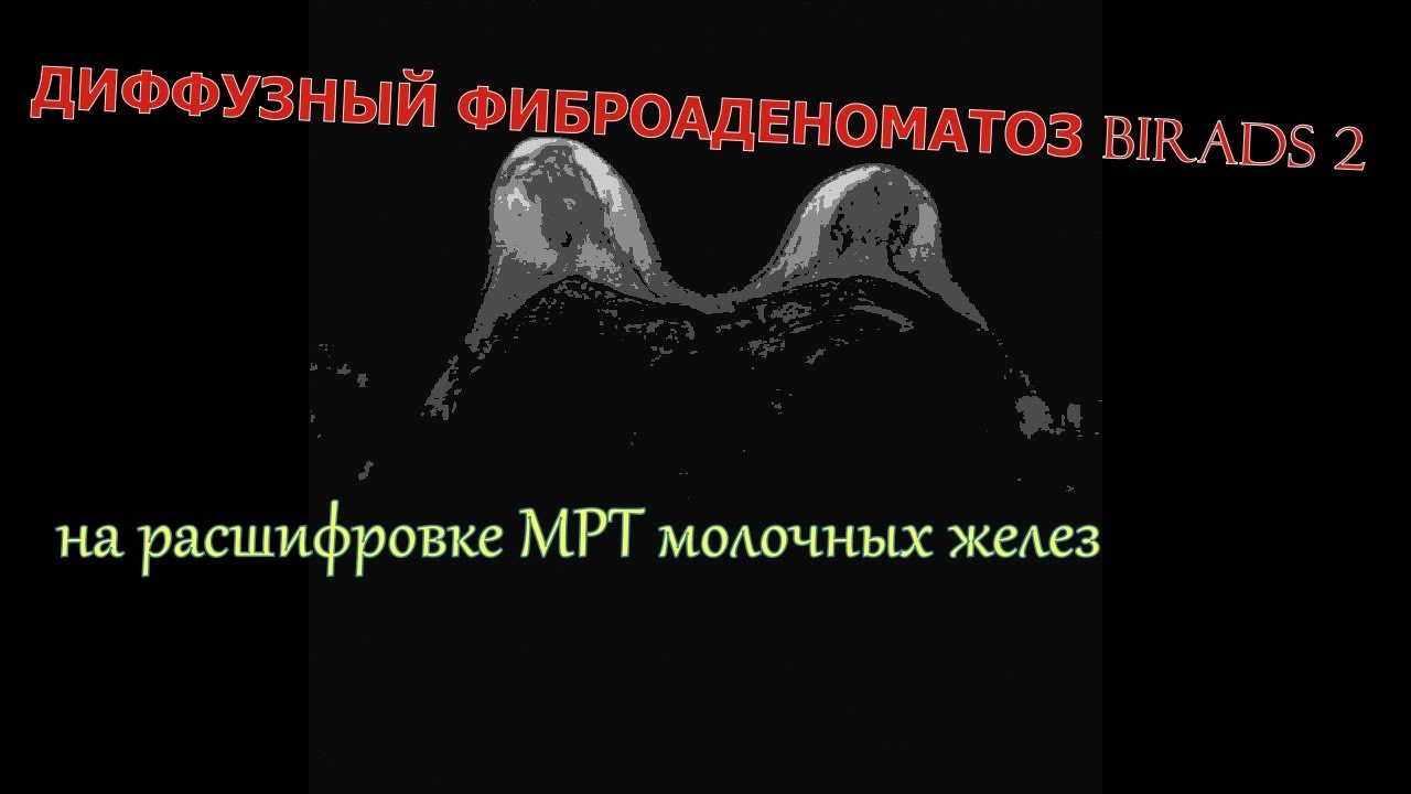 Рисунок изменен по типу фиброаденоматоза с преобладанием фиброзного компонента