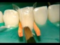 Restauration avec du composite du classe IV