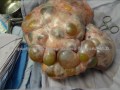 Tumor bizarro de ovario. (ovarian cancer).