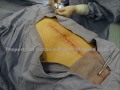 Tumor bizarro de ovario. (ovarian cancer).