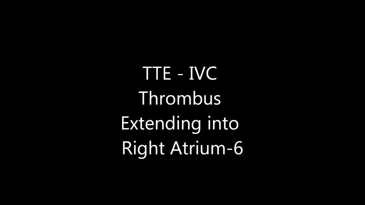 IVC Thrombus Extending into Right Atrium - Transthoracic Echocardiogram