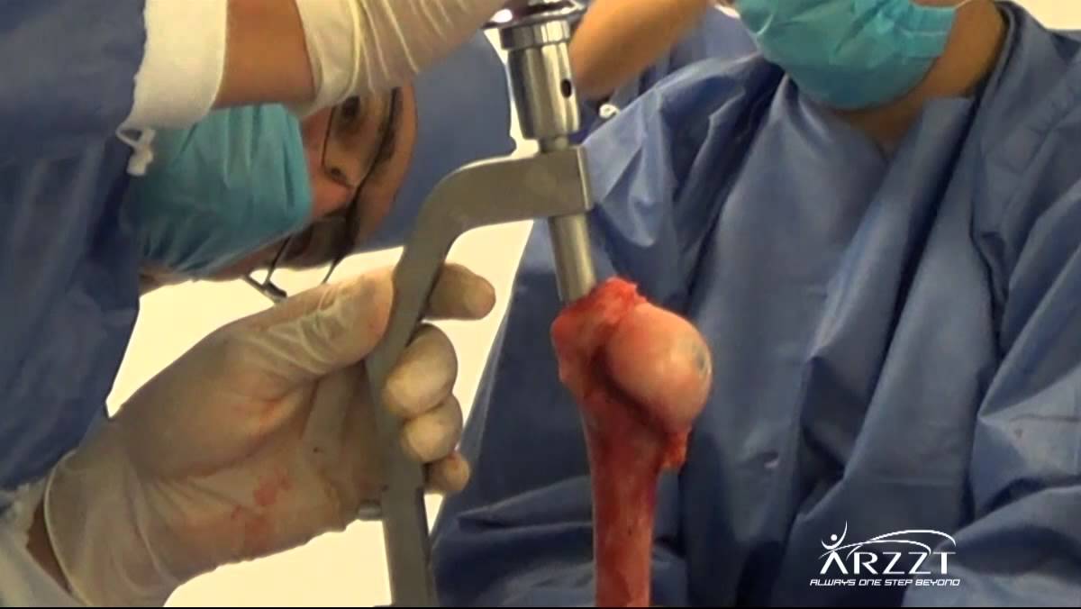 Intramedullary Nail System by Trauma Orthopedic Surgeons for fracture
