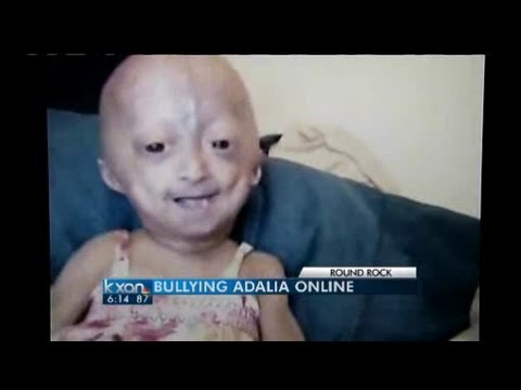 Cyber Bullying Of Child With Rare Disease Youtube