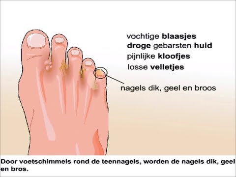 schimmelinfectie huid witte vlekken