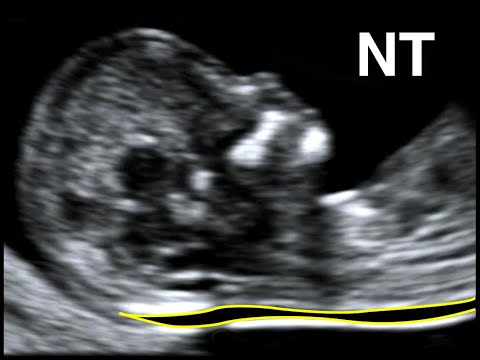 How to perform Nuchal Translucency Scan - YouTube