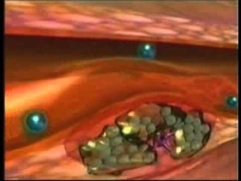 Trattamento di risposta laser varicosity