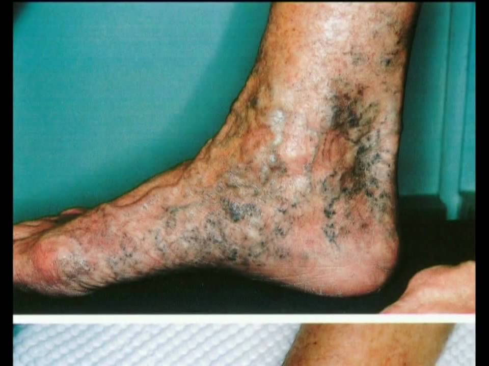 Coagulo di sangue in una vena esterna in una gamba