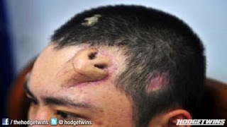 Man Has Nose Growing On His Forehead Reaction