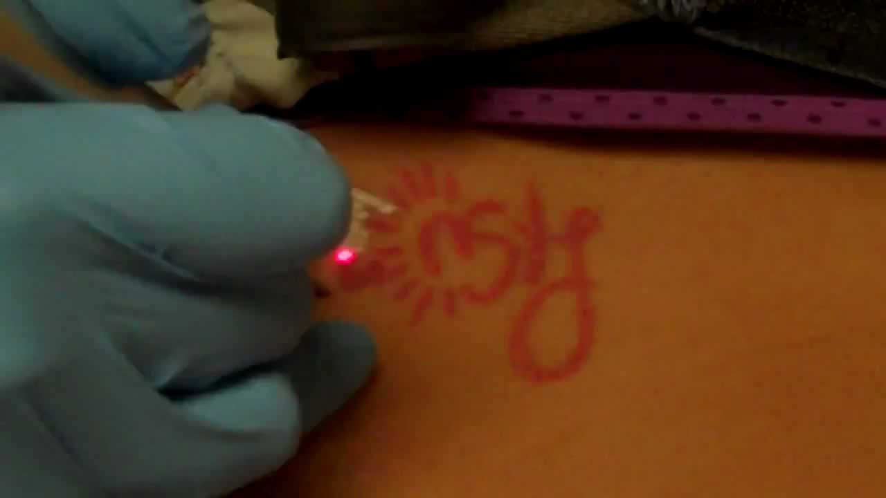 Laser Tattoo Removal - Pink Ink - YouTube
