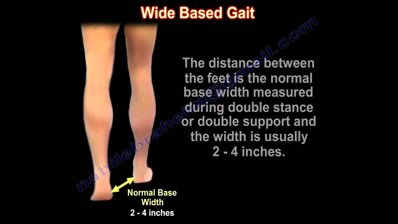 Wide Based Gait, Myelopathy Gait - Everything You Need To Know - Dr