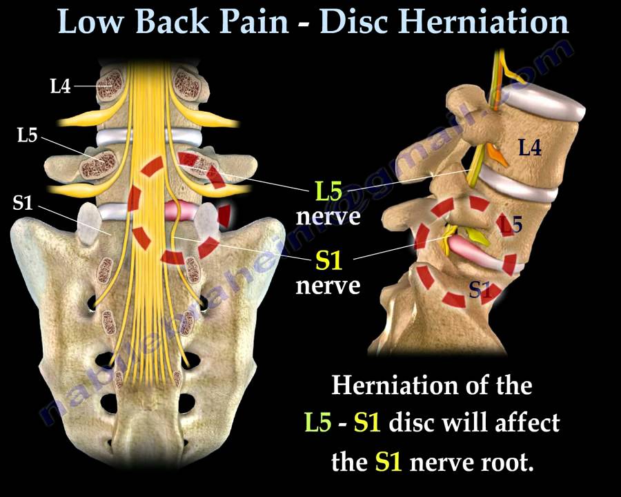 Low Back Pain - Disc Herniation ,Sciatica - Everything You Need To Know