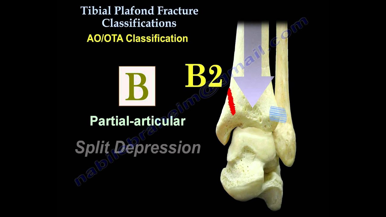 tibial plafond