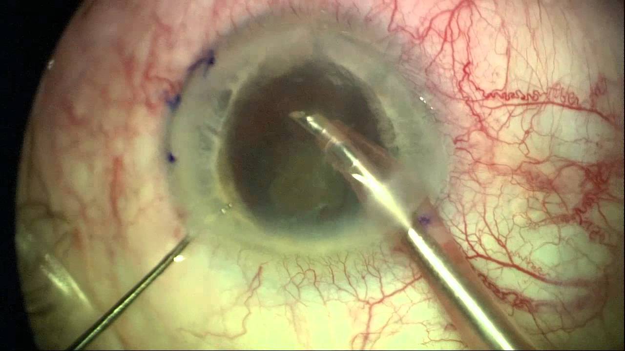 Cataract Surgery with a Limbal Relaxing Incision (LRI) to