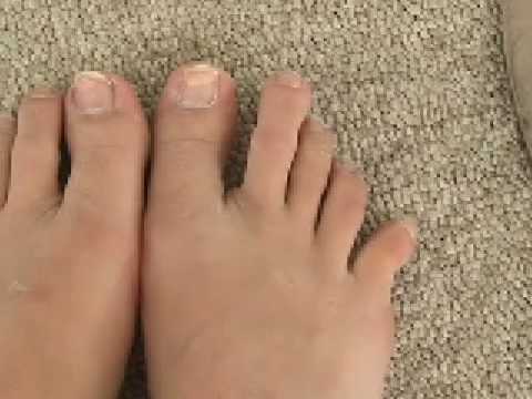 broken toe - YouTube