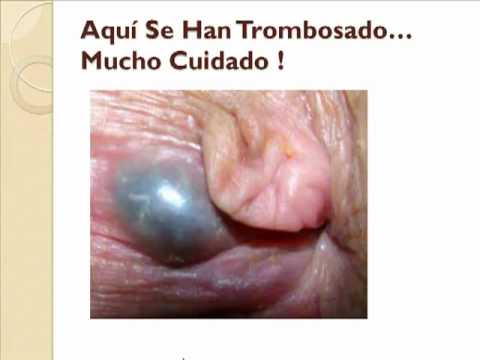 HEMORROIDE EXTERNA hemorroide externa: