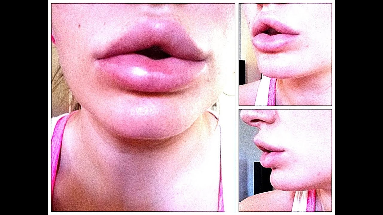 Long hanging lips