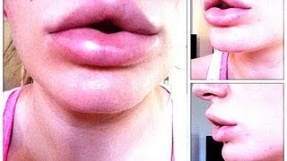 HARMLOSE NEBENWIRKUNG!? HYALORONSÄURE zum Lippenaufspritzen