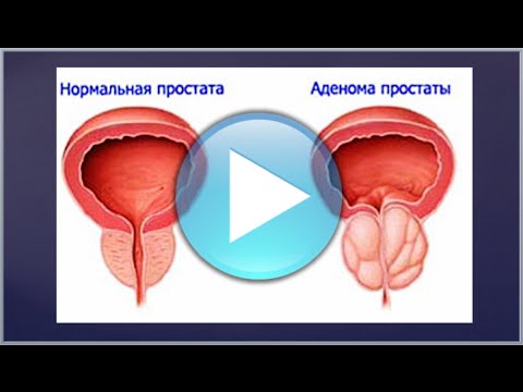 Аденома предстательной саратов Аденома предстательной саратов
