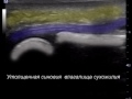 Нажмите для просмотра : Теносиновит сухожилия сгибателя 2 пальца стопы