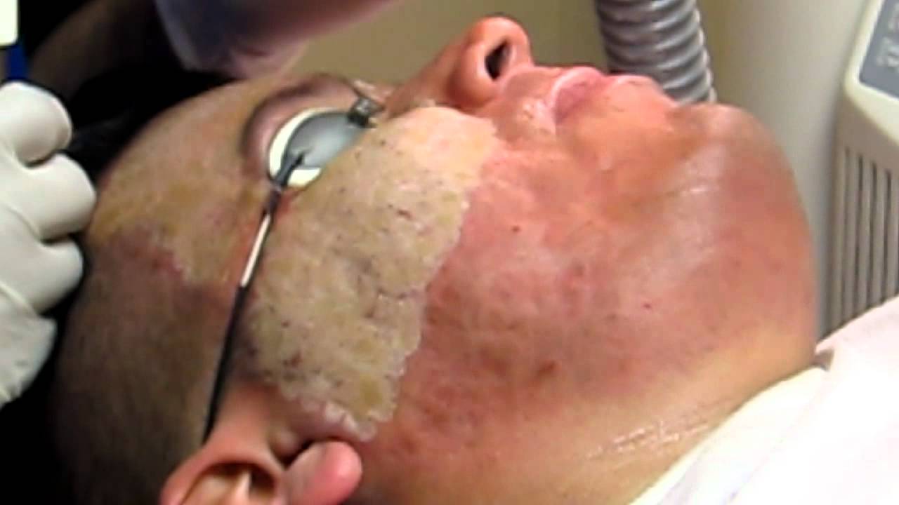 acne scar removal deep erbium laser peel pasadena burbank acne scar removal deep erbium laser peel pasadena burbank