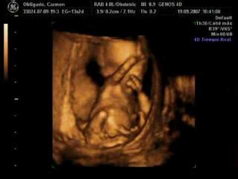 My baby ultrasound 13 weeks - YouTube