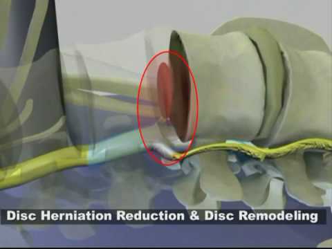 by Herniated Discs. Spinal by Herniated Discs. Spinal