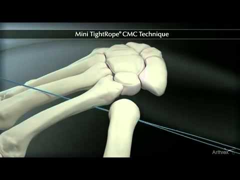 tightrope cmc mini technique arthrex arthroplasty