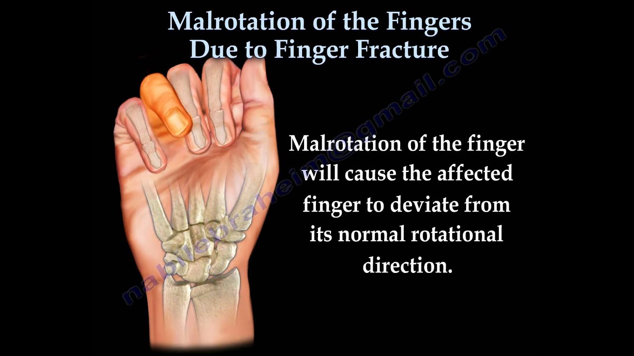 Finger Fractures Malrotation Of The Fingers - Everything You Need To