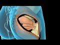 3D Medical Animation: Total Hip Joint Replacement Surgery (THR)