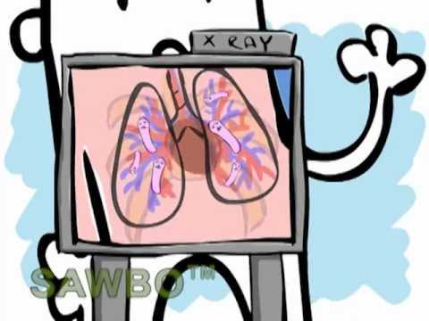 Tuberculosis Prevention in English (accent from the USA)