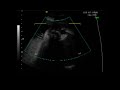 Thumbnail 1 for Ecografia 3D 4D 27 Semanas 5 Días De Embarazo Thumbnail 1 for Ecografia 3D 4D 27 Semanas 5 Días De Embarazo