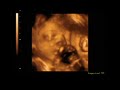 Thumbnail 2 for Ecografia 3D 4D 27 Semanas 5 Días De Embarazo Thumbnail 2 for Ecografia 3D 4D 27 Semanas 5 Días De Embarazo