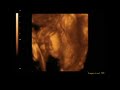 Thumbnail 3 for Ecografia 3D 4D 27 Semanas 5 Días De Embarazo Thumbnail 3 for Ecografia 3D 4D 27 Semanas 5 Días De Embarazo