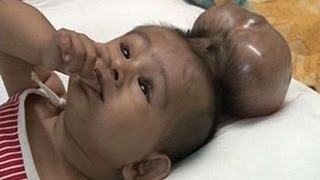 Baby Born With Two Heads - Extraordinary Birth