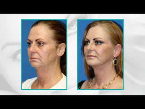 Facial Plastic Surgery Before and After : 15 Years Younger