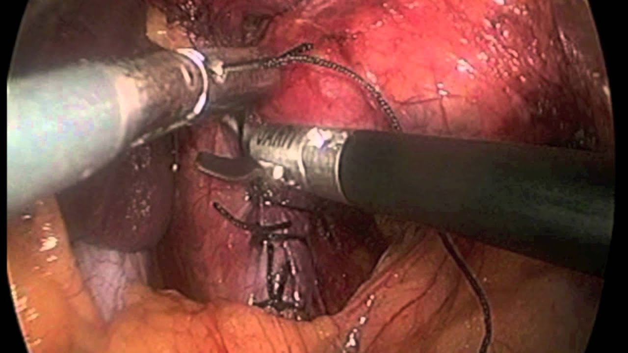 Surgery for GERD, Hiatal Hernia Repair, Nissen Fundoplication 