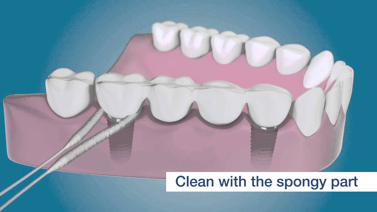 dental implants implant dentist floss bridge clean care tepe around wallpapers cleaning bridges hygiene fixed flexible nobel