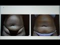 Video: Liposuction Before and After Videos